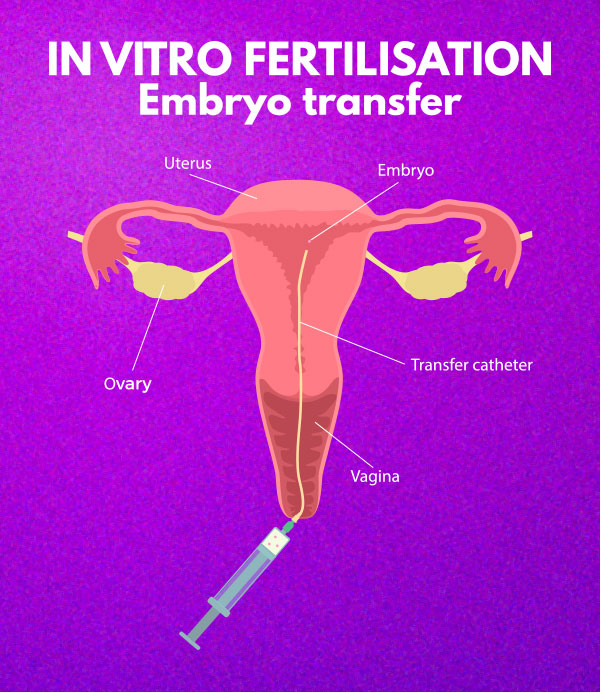 Embryo transfer procedure