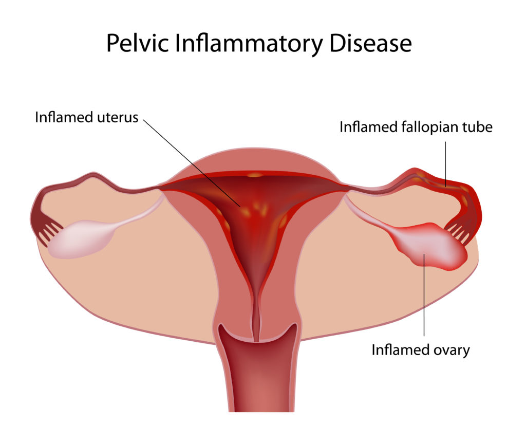 Pelvic Inflammatory Disease